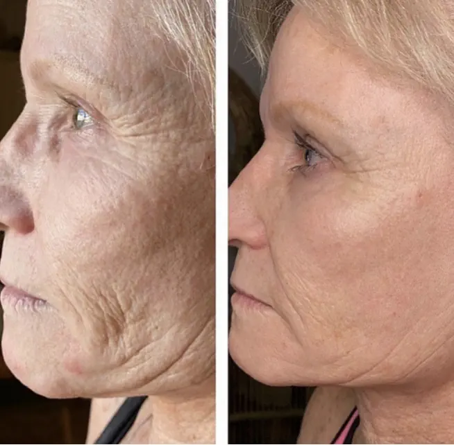 قبل و بعد پلاسما جت