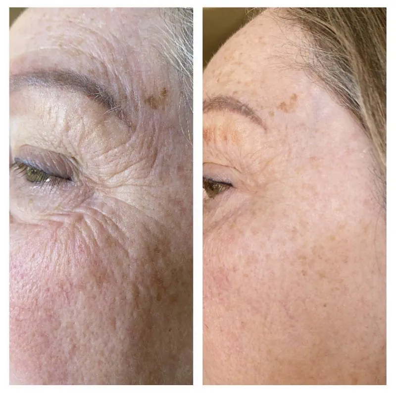 قبل و بعد پلاسما جت